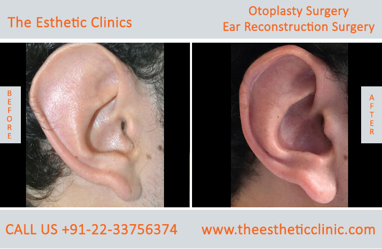 Otoplasty, Ear reconstruction surgery before after photos in mumbai india (5)